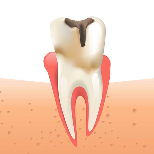 tooth with decay